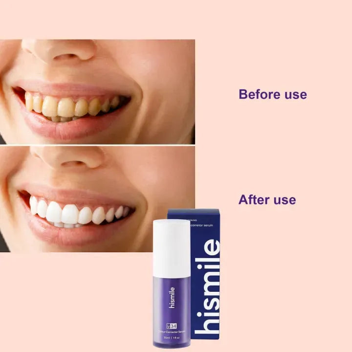 Hismile v34 teeth whitening