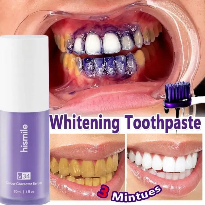 Hismile v34 teeth whitening